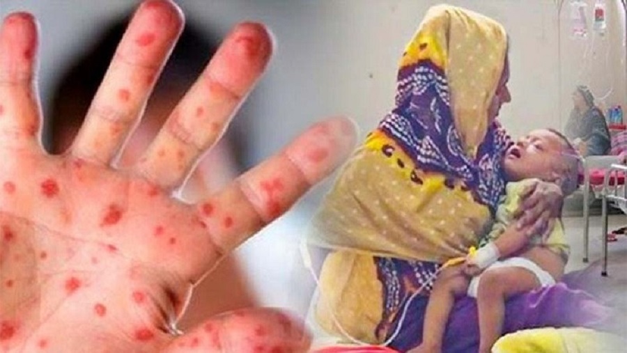চট্টগ্রামে বাড়ছে হাম সন্দেহভাজন রোগী, হাসপাতালে ভর্তি ৯২ জন